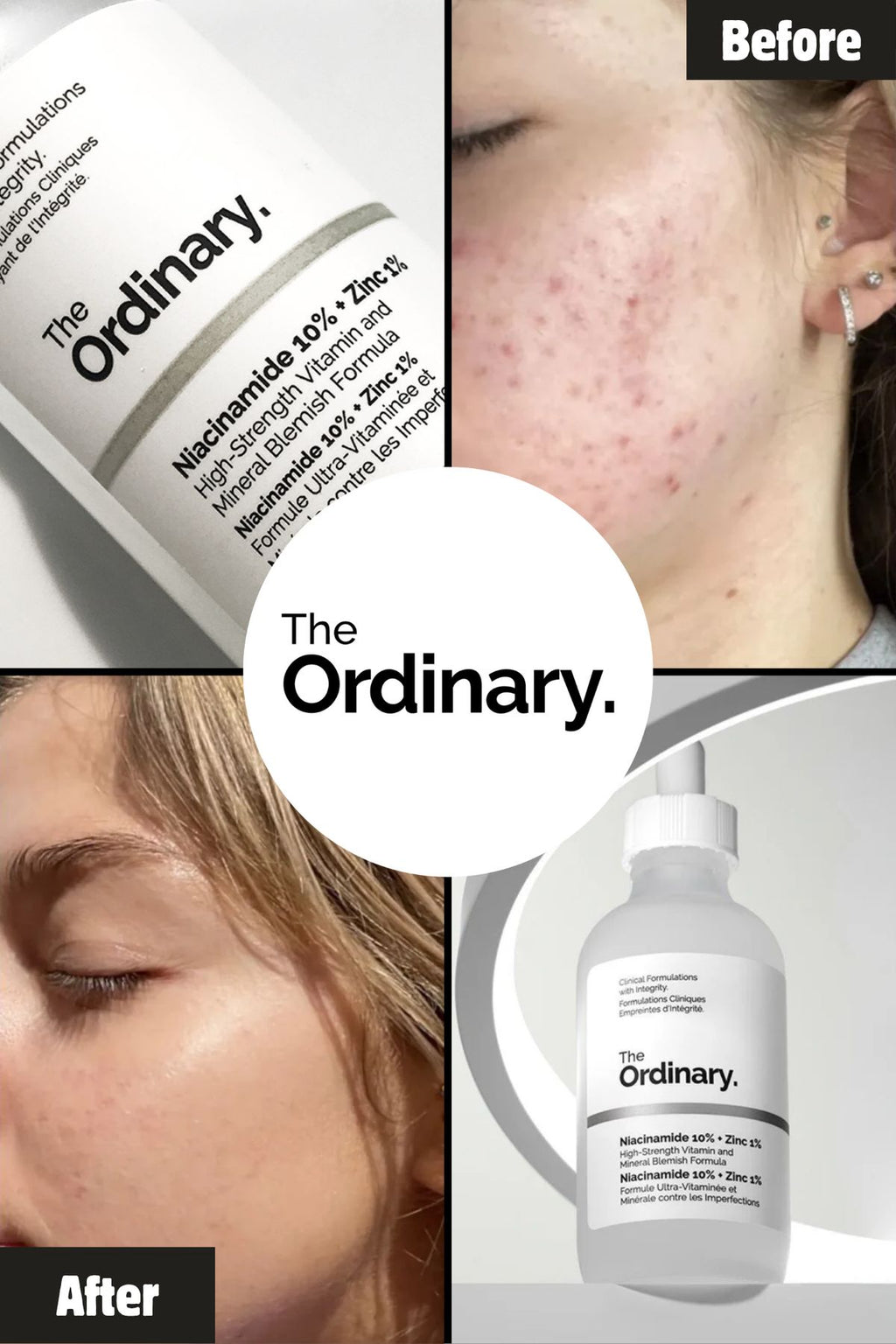 The Ordinary Niacinamide 10% + Zinc 1% 30ml – Acne & Oil Control Serum (Original)