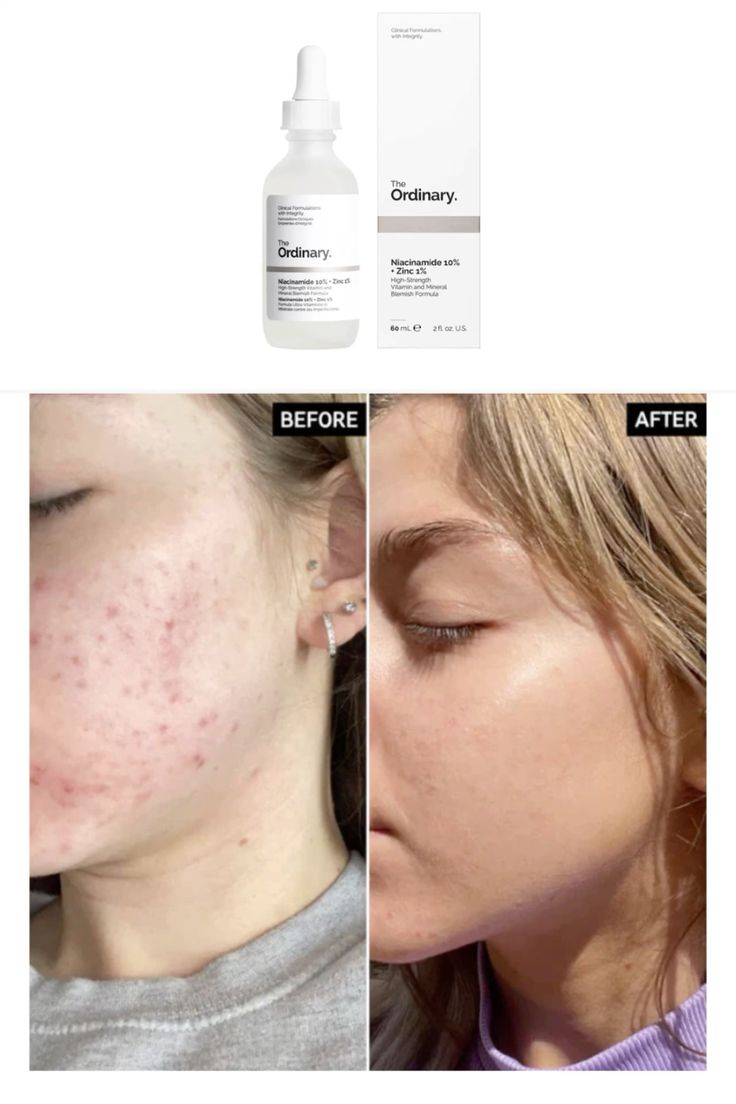 The Ordinary Niacinamide 10% + Zinc 1% 30ml – Acne & Oil Control Serum (Original)